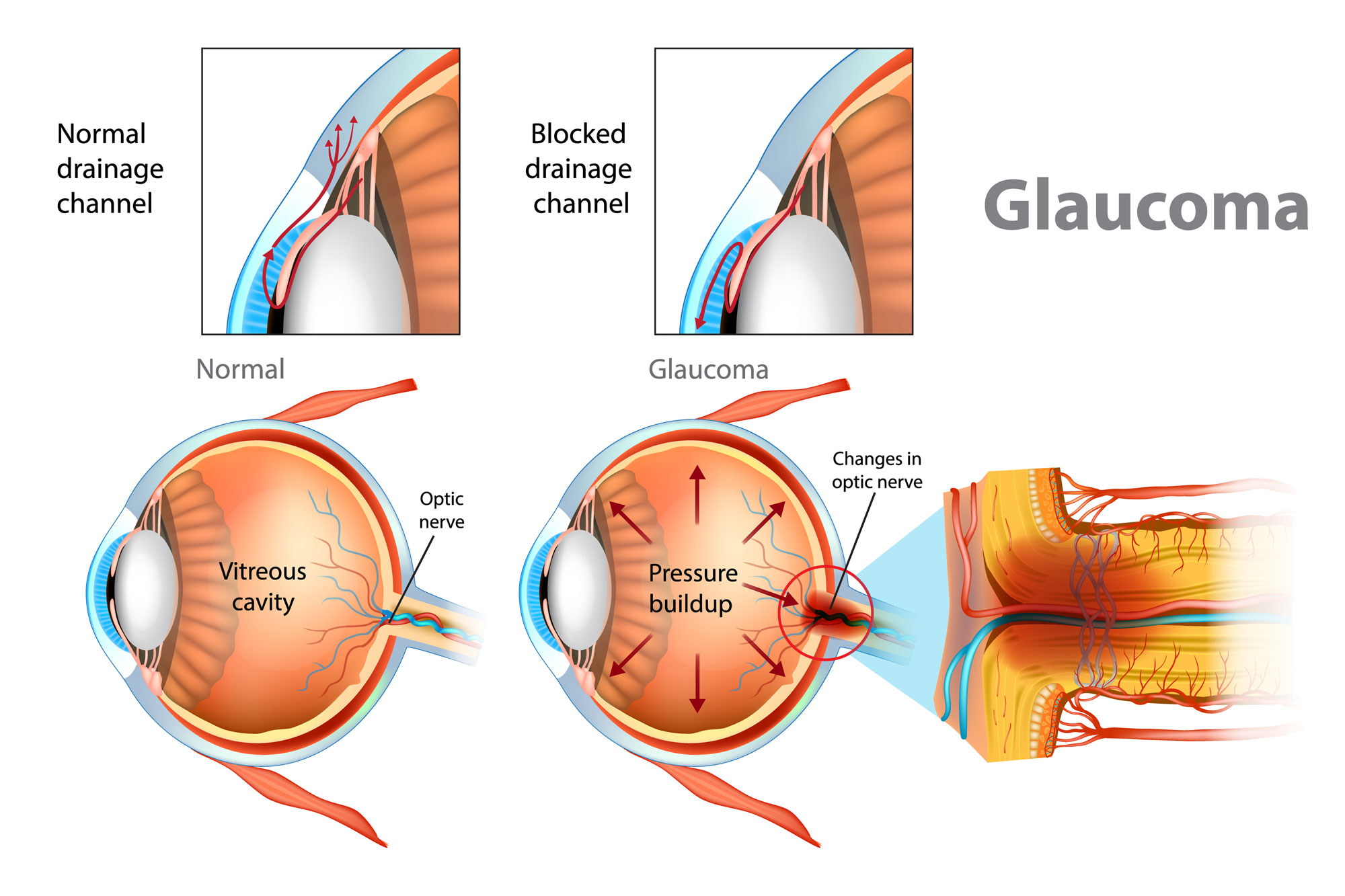 diagram of how glaucoma affects the eye. Simplified drawing of an eyeball from the side, showing an inflamed optic nerve towards the back of the eye.