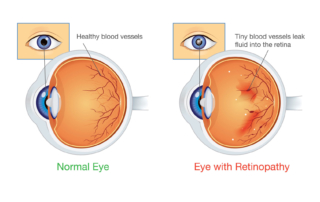 Simplified drawing of two eyeballs from the side, one with retinopathy and the other without. The normal eye is listed as having “healthy blood vessels.” The eye with retinopathy is listed as having “tiny blood vessels that leak fluid into the retina.”