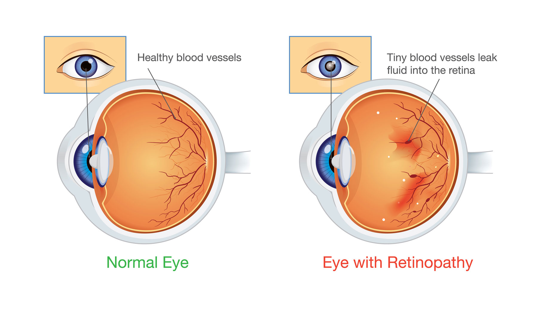 Simplified drawing of two eyeballs from the side, one with retinopathy and the other without. The normal eye is listed as having “healthy blood vessels.” The eye with retinopathy is listed as having “tiny blood vessels that leak fluid into the retina.”